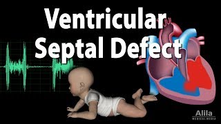 Ventricular Septal Defect Animation [upl. by Holly-Anne474]