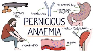 Understanding Pernicious Anaemia B12 Deficiency [upl. by Laud]