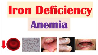 IronDeficiency Anemia Overview  Causes Pathophysiology Signs amp Symptoms Diagnosis Treatment [upl. by Norym]