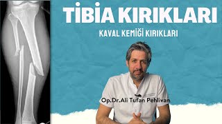 Kaval Kemiği Tibia  Kırıkları [upl. by Cristionna]