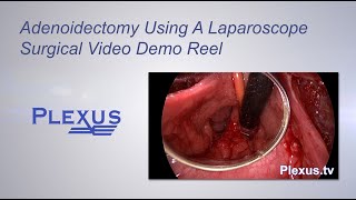 Adenoidectomy Surgical Video [upl. by Ameerahs417]