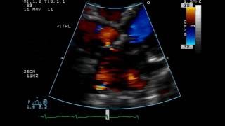 Atrial Septal Defect  Ostium Secundum Type  TTE [upl. by Annuhsal]