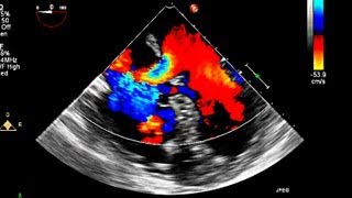 Atrial Septal Defect Primum Echocardiography [upl. by Lauzon618]